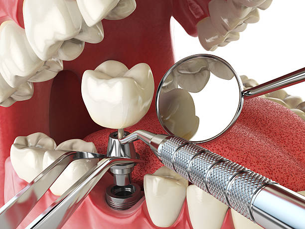 Best Dentist for Tooth Abscess  in New Vienna, OH
